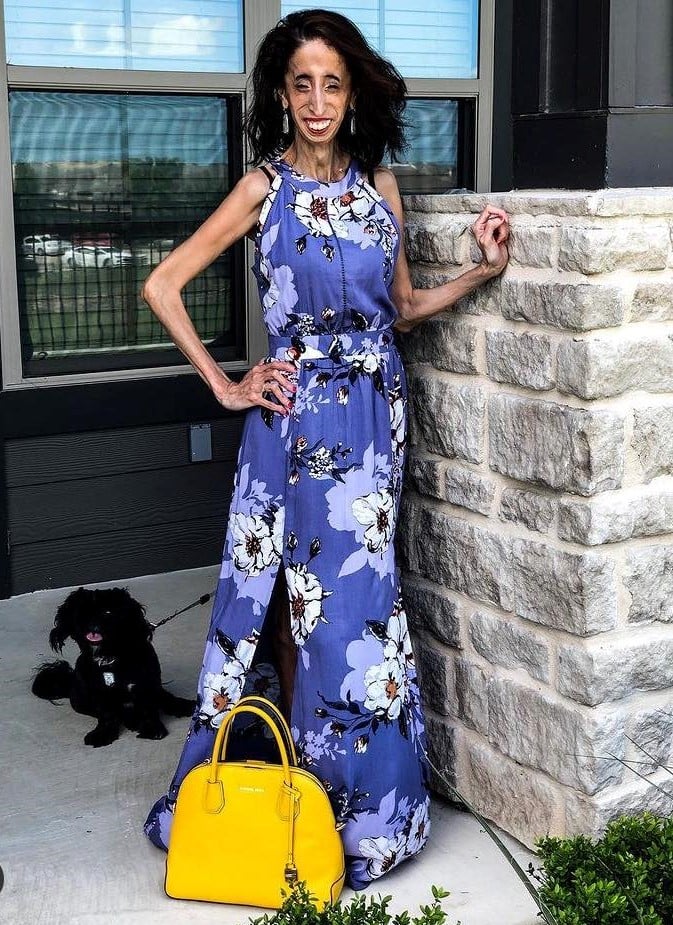 នាង Lizzie Velasquez
