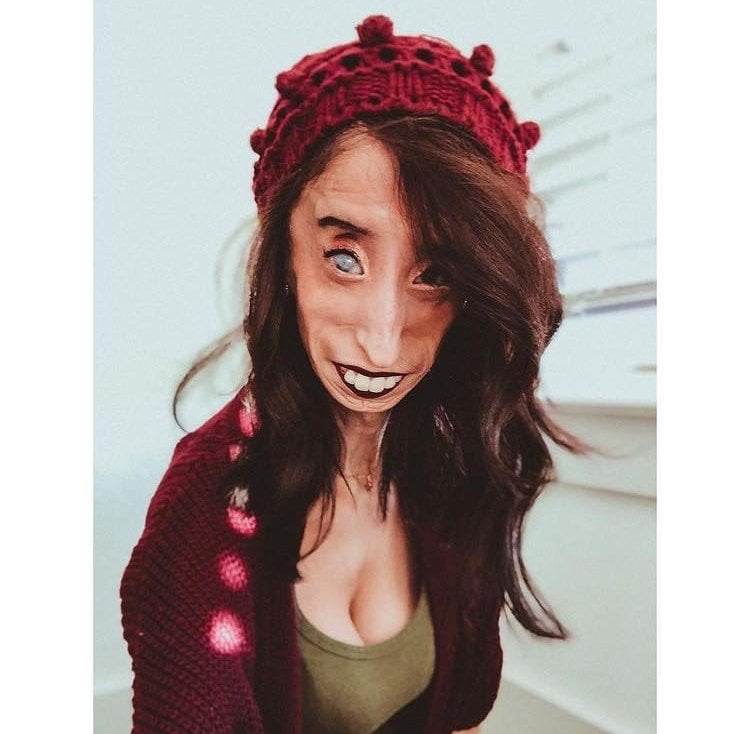 នាង Lizzie Velasquez