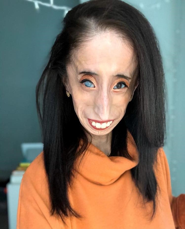 នាង Lizzie Velasquez