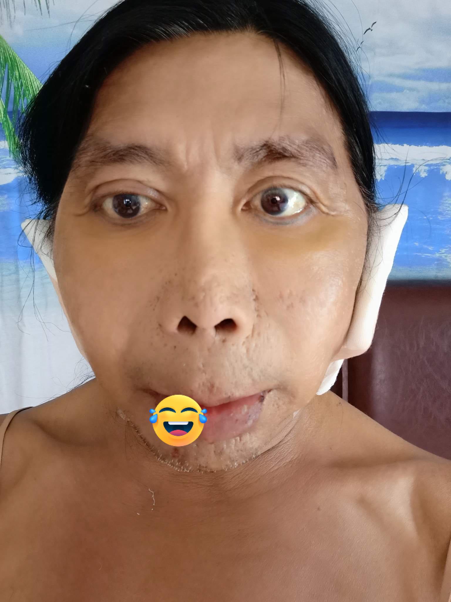 រូបភាព Sitang ក្រោយពីកែសម្ផស្ស