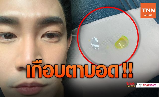 หวิดตาบอด!! "ฟลุค จิระ" แชร์ประสบการณ์ คอนแทคเลนส์ขาดจนตาอักเสบ