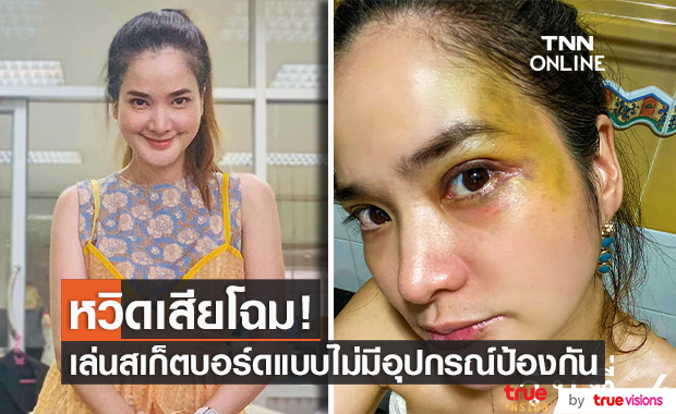 "ปอย ปวีณา" โพสต์ตาเขียวช้ำ เป็นอุทาหรณ์จากการเล่นสเก็ตบอร์ด