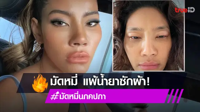 "มะหมี่ นภคปภา" เกิดอาการแพ้น้ำยาซักผ้ารุนแรง ถึงขั้นหายใจไม่ออก ตาบวม