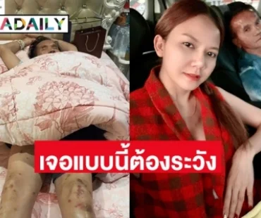 “จ๊ะ อาร์สยาม” เตือนภัย คุณพ่อสั่งยาเองจากทีวี ทำร่ายกายทรุด เนื้อตัวบวม