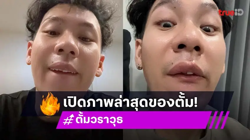 เปิดภาพล่าสุด ตั้ม วราวุธ หลังเกิดอุบัติเหตุหนัก เจ้าตัวบอก3วันดี4วันหาย(ฟัน)