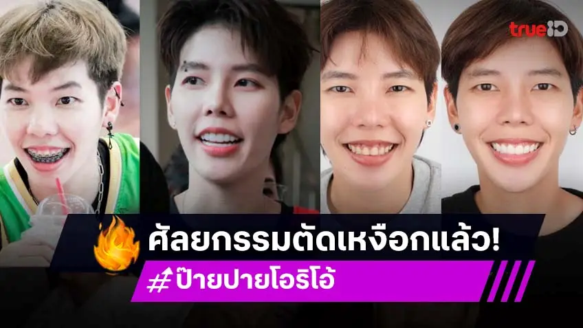 "ป๊ายปาย โอริโอ้" รับผ่าตัดเหงือก เสริมความมั่นใจ!