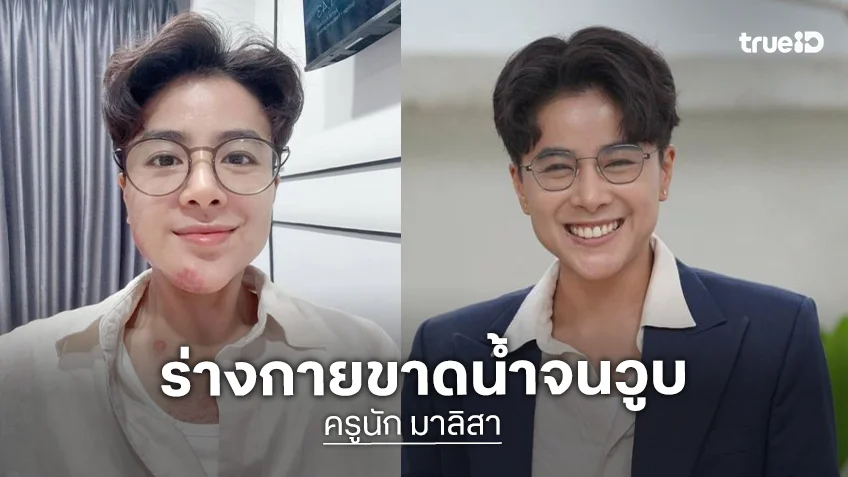 นักร้องเวทีดัง วูบล้มหน้าคว่ำคางแตก เหตุร่างกายขาดน้ำ
