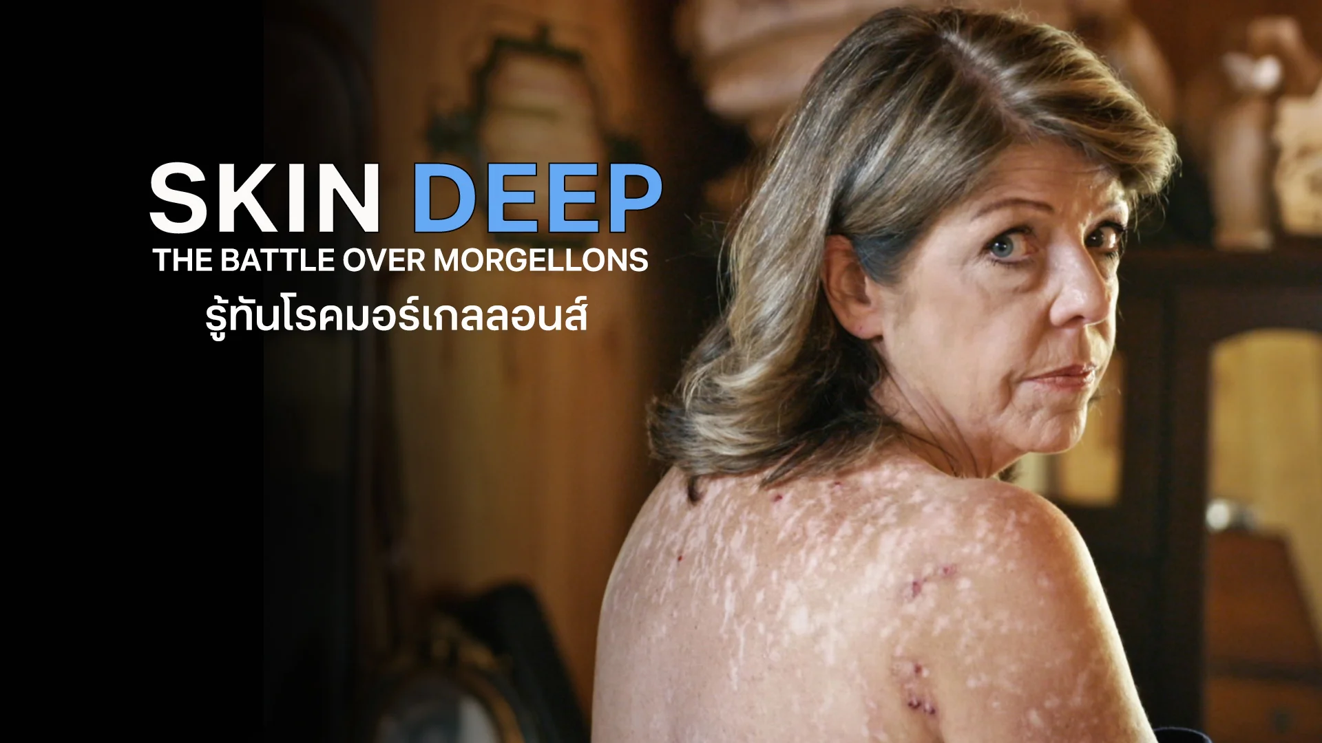 Skin Deep The Battle Over Morgellons - Watch Movies Online