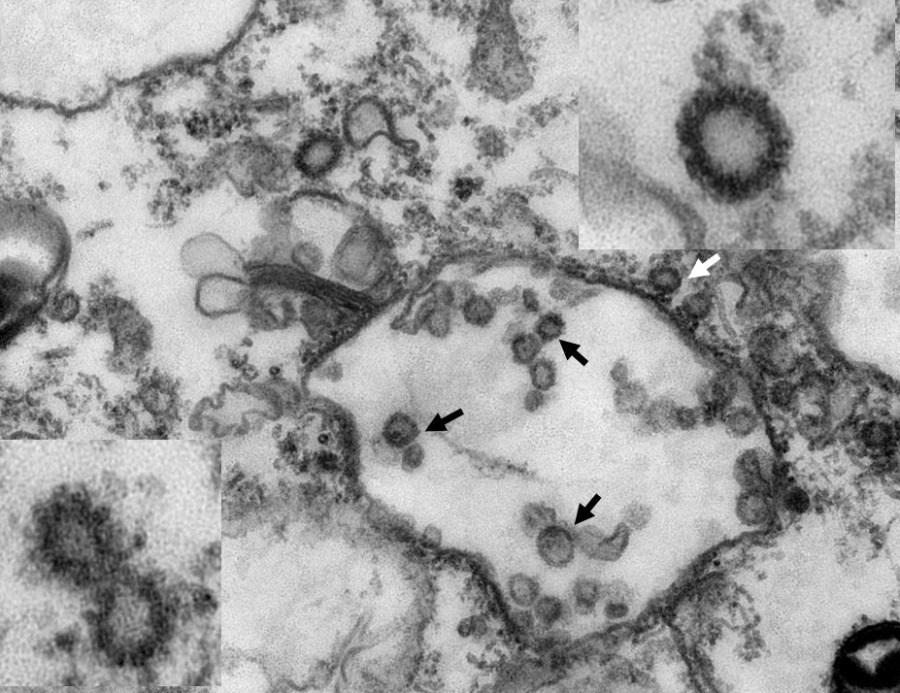 โควิด:WHOเตือน ยังไม่มีหลักฐาน คนติดเชื้อไวรัสโคโรนาแล้วมีภูมิคุ้มกัน