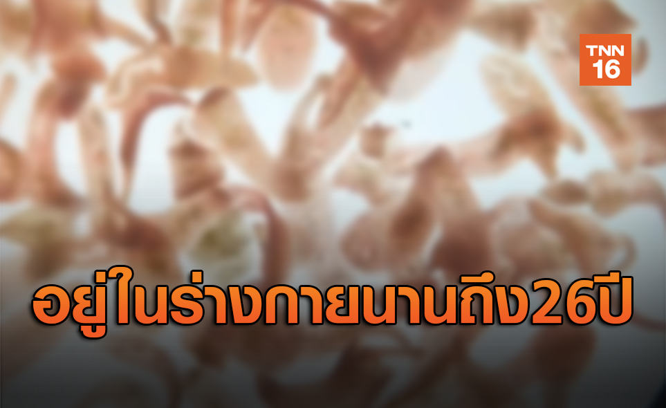 เชื้อ! พยาธิใบไม้ตับ อยู่ในร่างกายมนุษย์ได้นานสุดถึง 26 ปี