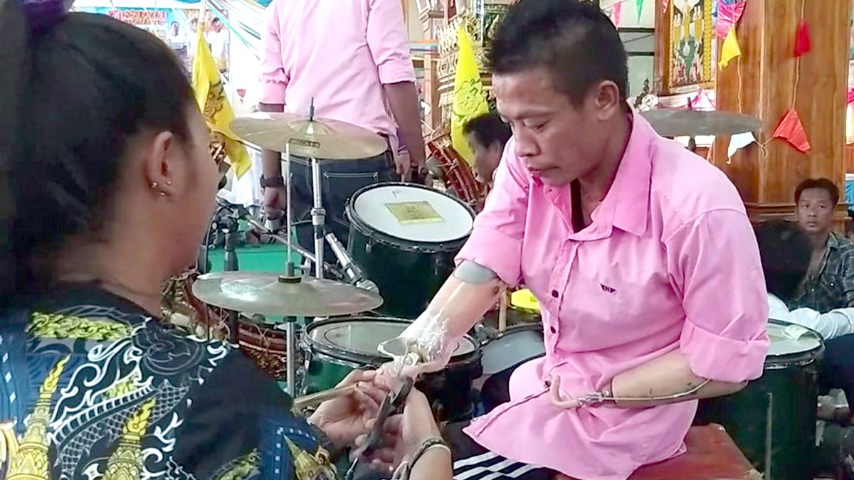 หนุ่มถูกไฟชอร์ต โดนตัดแขนขา ไม่ท้อเดินหน้าสู้ต่อ รับจ้างตีกลองหาเลี้ยงลูก-เมีย