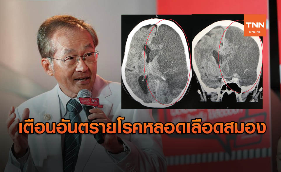 หมอมนูญ เตือน "โรคหลอดเลือดสมอง" คร่าชีวิตคนไทยอันดับ 3