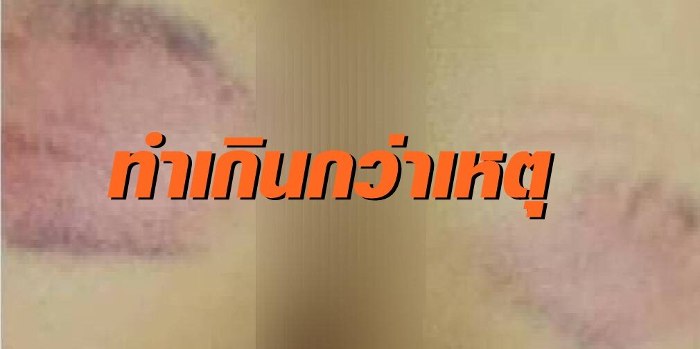 ผู้ปกครองสุดทน เตรียมเอาเรื่องครูหลังตีลูกสาวจนก้นช้ำ ชี้ทำเกินกว่าเหตุ และไม่ใช่ครั้งแรก