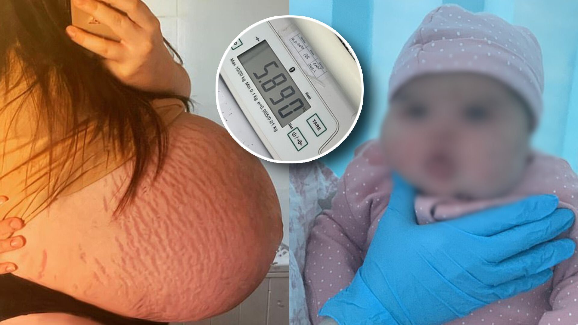 สาวท้องแรก เล่า ท้องใหญ่เกิน จนเจอปัญหาหนัก ก่อนคลอดลูกสาวหนัก 5 กก.กว่า
