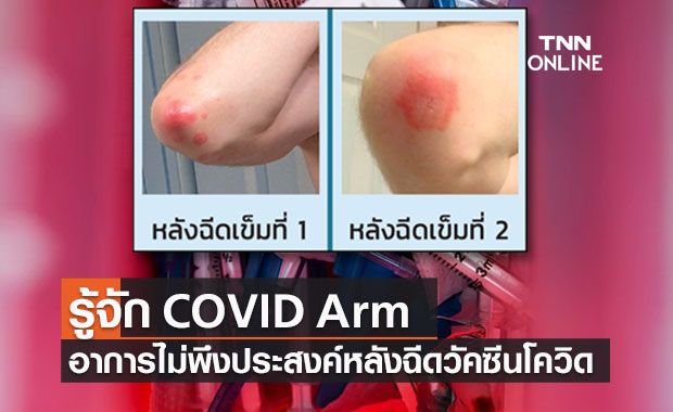 รู้จัก COVID Arm อาการไม่พึงประสงค์หลังฉีดวัคซีนโควิดชนิด mRNA รู้จัก COVID Arm อาการไม่พึงประสงค์หลังฉีดวัคซีนโควิดชนิด mRNA