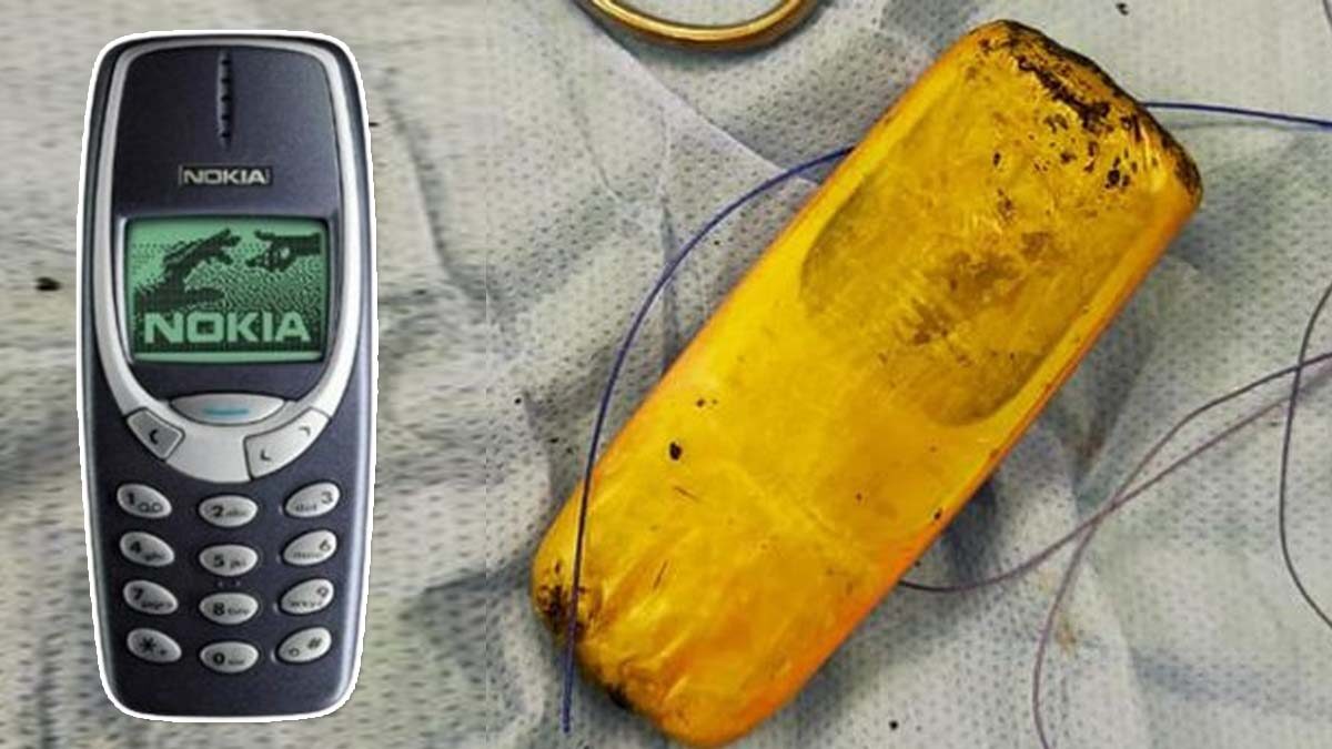 กลุ่มแพทย์มึน! พบโทรศัพท์มือถืออยู่ในท้องของชายชาวอียิปต์กว่าครึ่งปี