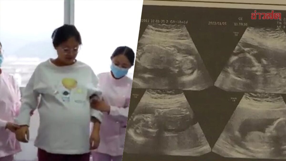 หญิงท้องแฝดสี่ คลอดก่อนกำหนดคนละวัน หมอยื้ออีก 2 คนอยู่ในท้องข้ามเดือน