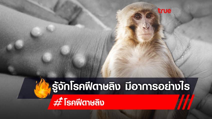 รู้จัก "โรคฝีดาษลิง" (Monkeypox) มีตุ่มหนองคัน ติดต่อจากการสัมผัส คล้ายไวรัสไข้ทรพิษ