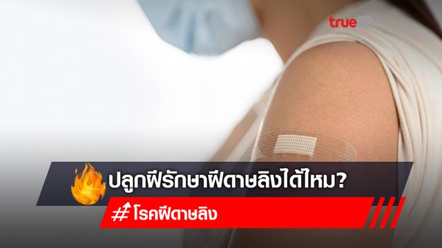 เช็กด่วน! "ปลูกฝี" รักษา "ฝีดาษลิง" ได้ไหม? หลังทั่วโลกยกเลิกการปลูกฝี ตั้งแต่ปี พ.ศ 2523 เช็กด่วน! "ปลูกฝี" รักษา "ฝีดาษลิง" ได้ไหม? หลังทั่วโลกยกเลิกการปลูกฝี ตั้งแต่ปี พ.ศ 2523