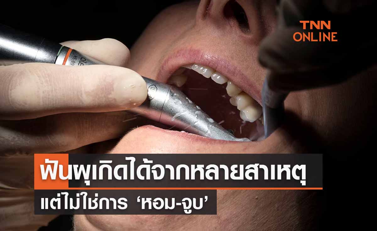 โรคฟันผุ เกิดจากหลายสาเหตุใม่ใช่จากการ ‘หอม-จูบ ’