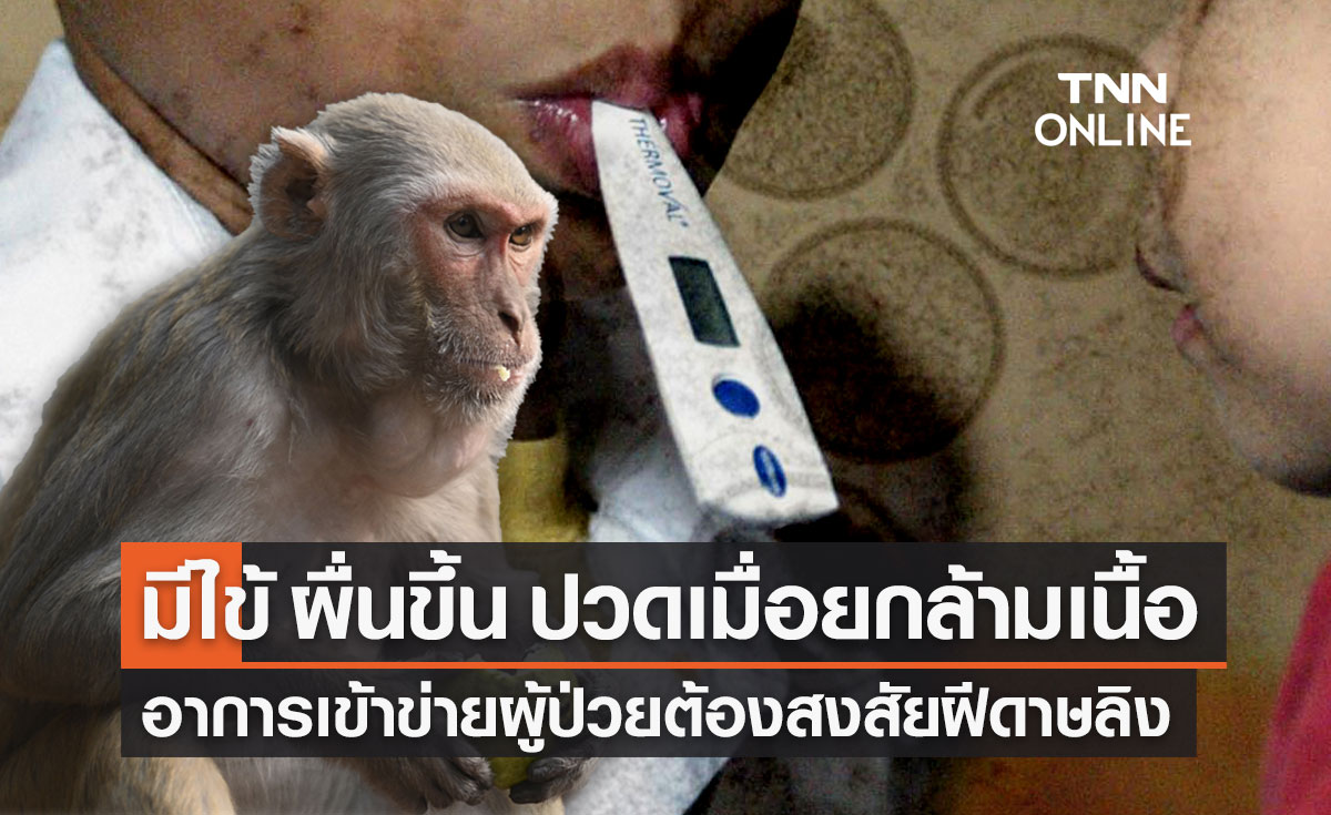 มีไข้ ผื่นหรือตุ่มขึ้น ปวดเมื่อย เช็กอาการเข้าข่ายผู้ป่วยต้องสงสัย "ฝีดาษลิง"