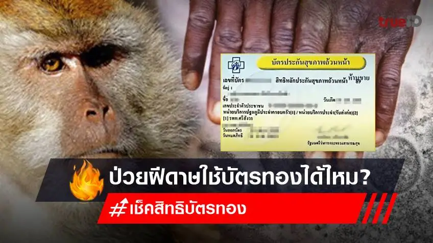 เช็คสิทธิบัตรทอง 2565 ใช้บัตรทอง 30 บาท รักษา "ฝีดาษลิง" ได้ไหม?