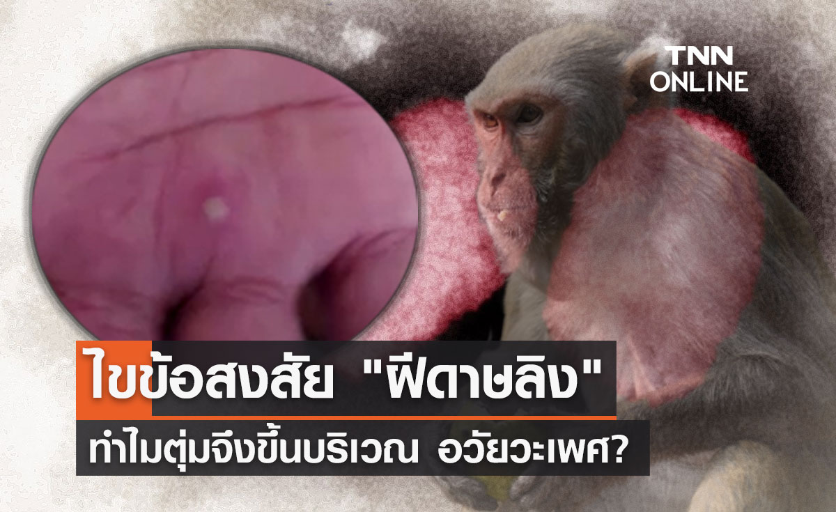 "ฝีดาษลิง" หมอยง ไขข้อสงสัย ทำไมตุ่มจึงขึ้นบริเวณอวัยวะเพศ?