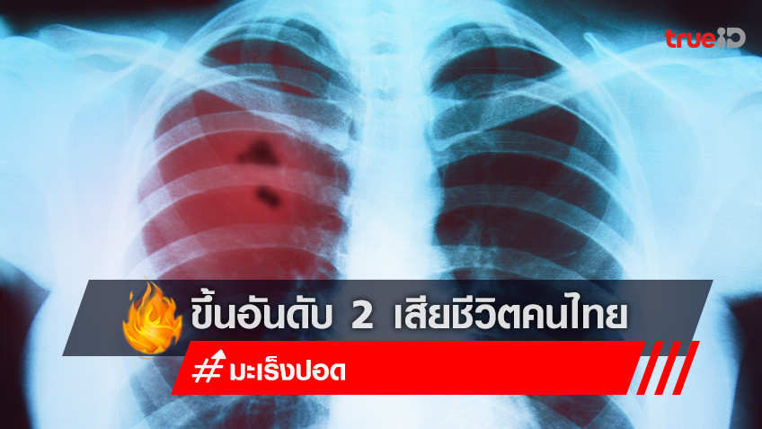 แพทย์ ชี้ มะเร็งปอด ขึ้นอันดับ 2 เหตุเสียชีวิตของคนไทย