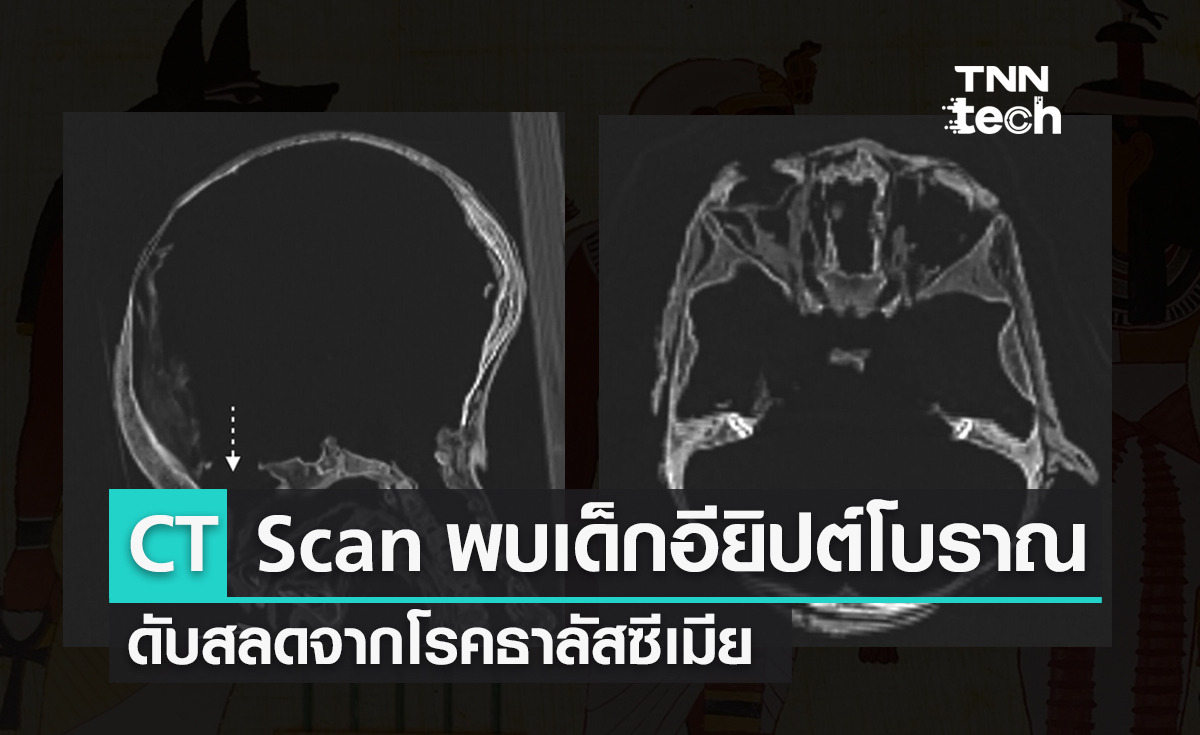 CT Scan พบมัมมี่เด็กอียิปต์โบราณดับสลดจากโรคธาลัสซีเมีย