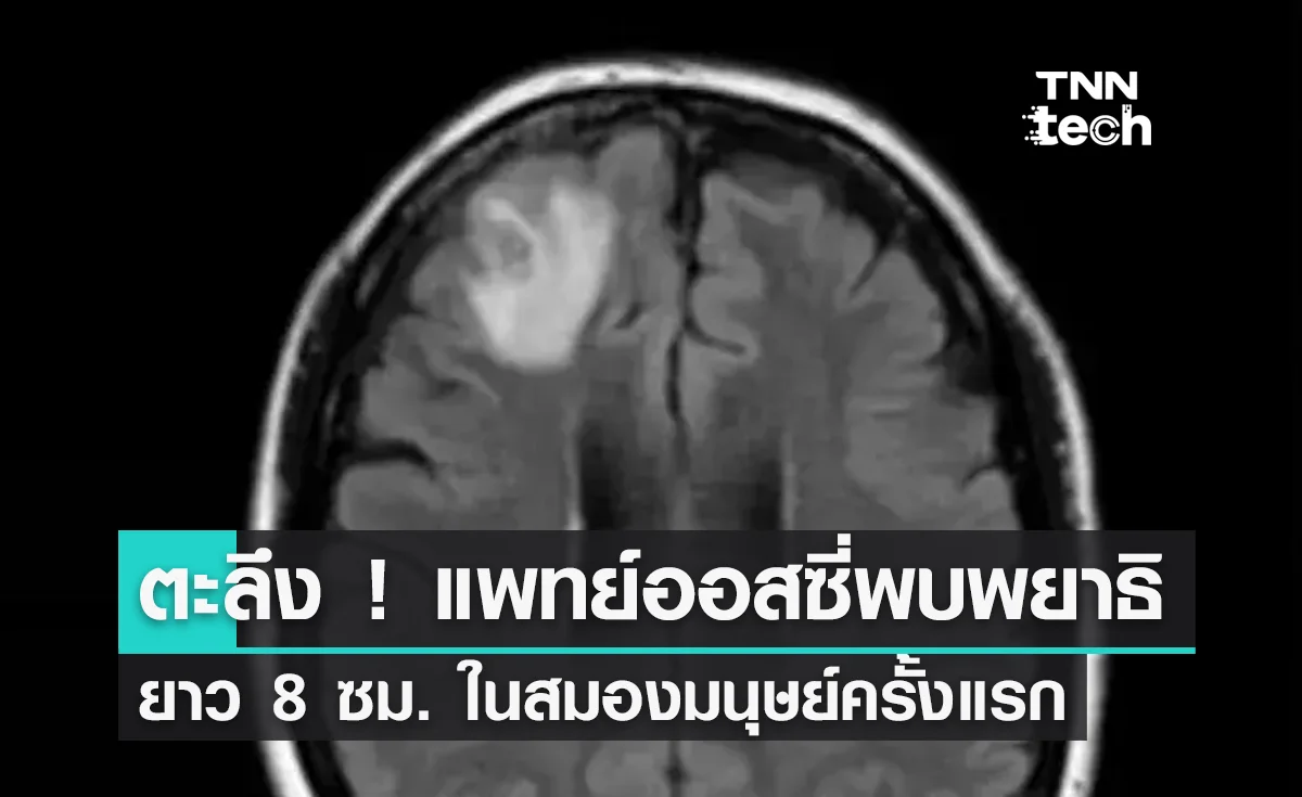 ตะลึง ! แพทย์ออสซี่พบพยาธิยาว 8 ซม. ในสมองมนุษย์ครั้งแรกของโลก