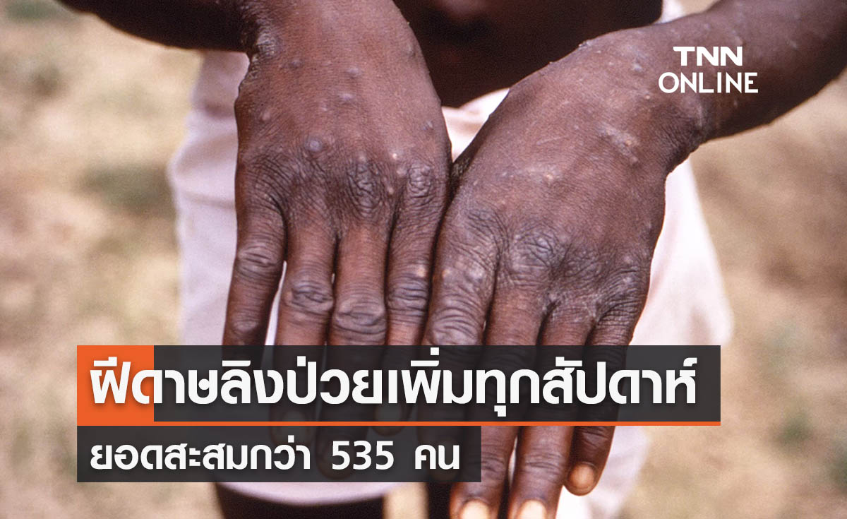 ‘โรคฝีดาษลิง’ ป่วยเพิ่มทุกสัปดาห์ ยอดสะสมล่าสุดติดเชื้อกว่า 535 คน