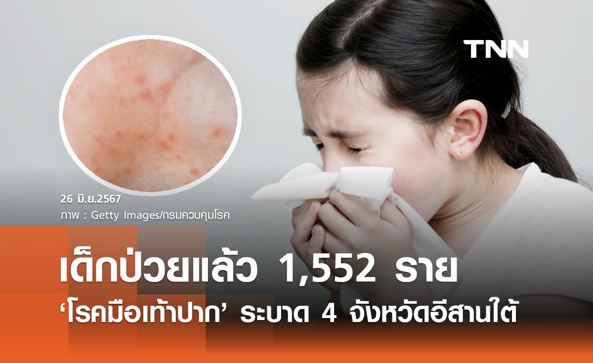 มือเท้าปากระบาด! เปิดเทอม 4 จังหวัดอีสานใต้ พบป่วยแล้ว 1,552 ราย