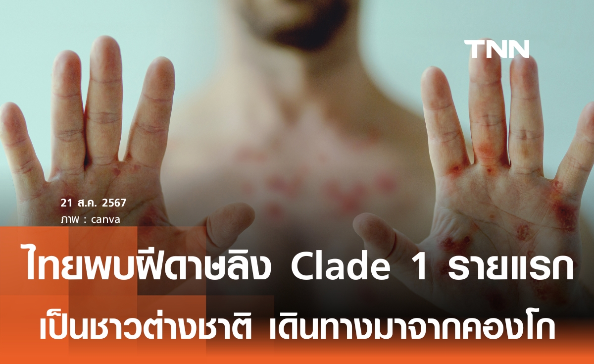 ไทยพบ"ฝีดาษลิง Clade 1"รายแรกเดินทางจากคองโก