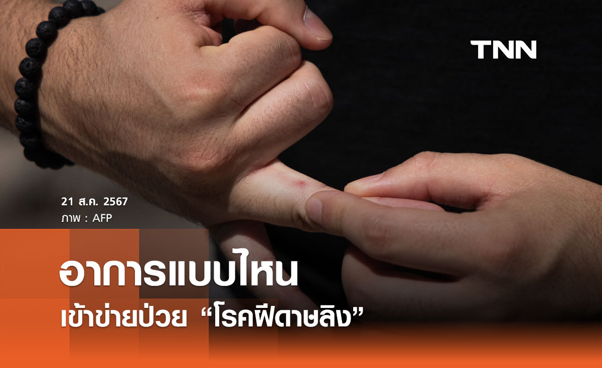 อาการแบบไหน เข้าข่ายป่วย “โรคฝีดาษลิง” ควรรีบไปพบแพทย์