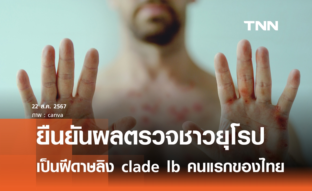 ยืนยันผลตรวจชาวยุโรปเป็น"ฝีดาษลิง clade Ib" รายแรกของไทย