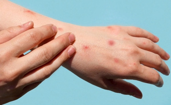 กรมการแพทย์ ขออย่าตื่นตระหนก โรคฝีดาษวานร ไม่ติดต่อง่าย-ติดจากสัมผัสใกล้ชิด