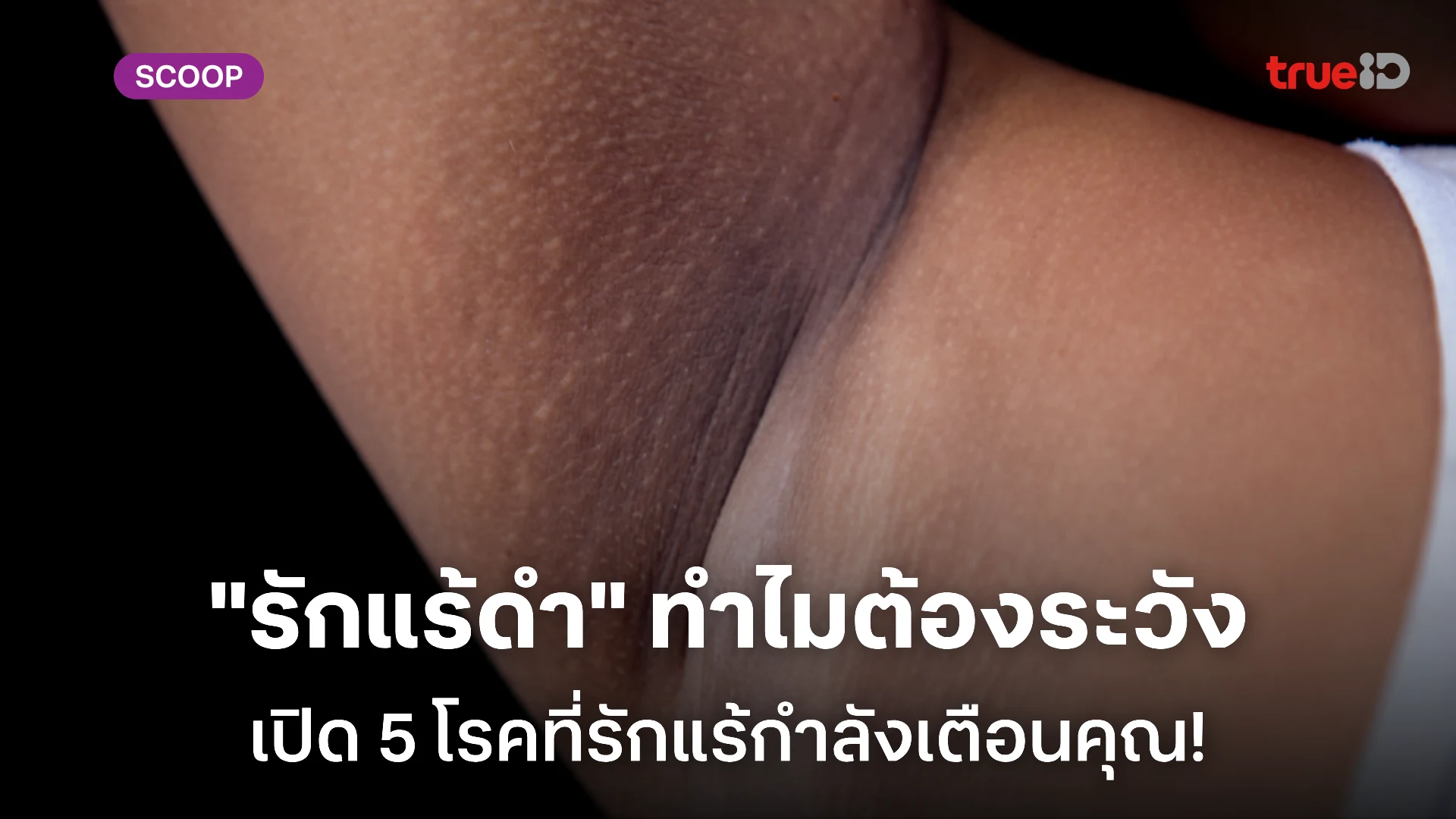รักแร้ดำเกิดจากอะไร แบบไหนที่เป็นสัญญาณเตือนโรค ผู้ชายรักแร้ดำควรระวัง! รักแร้ดำเกิดจากอะไร แบบไหนที่เป็นสัญญาณเตือนโรค ผู้ชายรักแร้ดำควรระวัง!