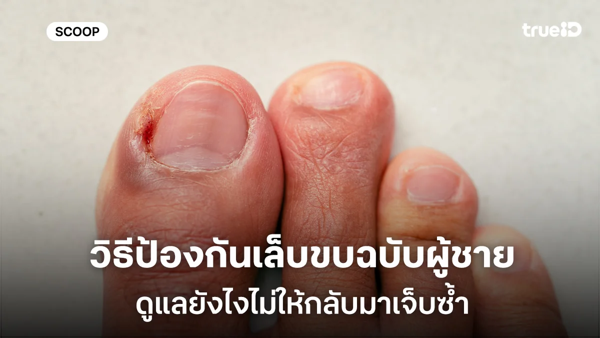 วิธีป้องกันเล็บขบฉบับผู้ชาย ต้องใส่รองเท้าทำงานทั้งวัน ดูแลยังไงไม่ให้กลับมาเจ็บซ้ำ