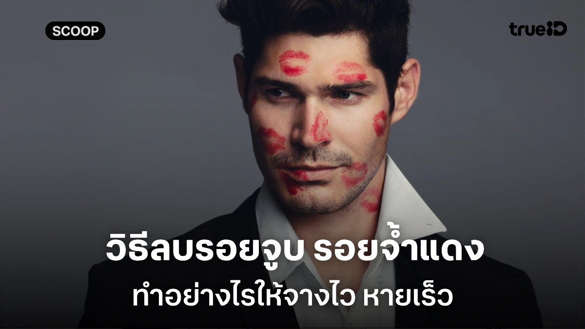 วิธีลบรอยจูบ รอยจ้ำแดงที่คอ ให้หายไว จางเร็ว