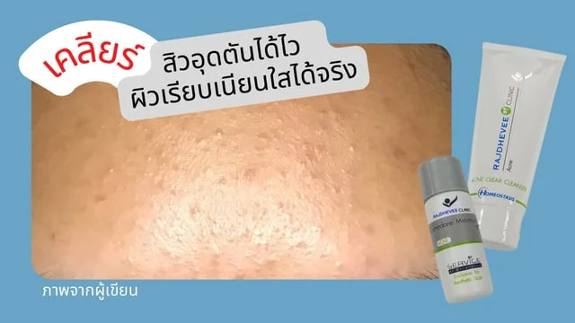 เคลียร์สิวอุดตันได้ไว ผิวเรียบเนียนใส วัยรุ่นต้องรู้กับ Acne clear cleanser และ pH balance ราชเทวีคลินิก