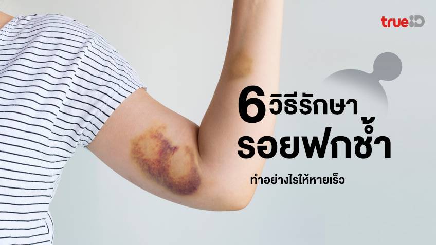 6 วิธีรักษารอยช้ำให้หายไว รอยฟกช้ำดำเขียว ทําอย่างไรให้หายเร็ว