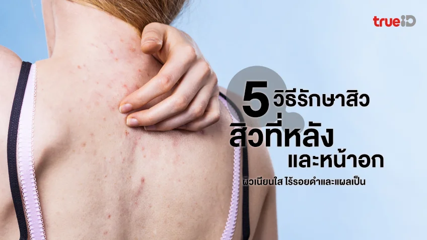 5 วิธีรักษาสิวที่หลังและหน้าอกแบบธรรมชาติ ผิวเนียนใส ไร้รอยดำและแผลเป็น 5 วิธีรักษาสิวที่หลังและหน้าอกแบบธรรมชาติ ผิวเนียนใส ไร้รอยดำและแผลเป็น
