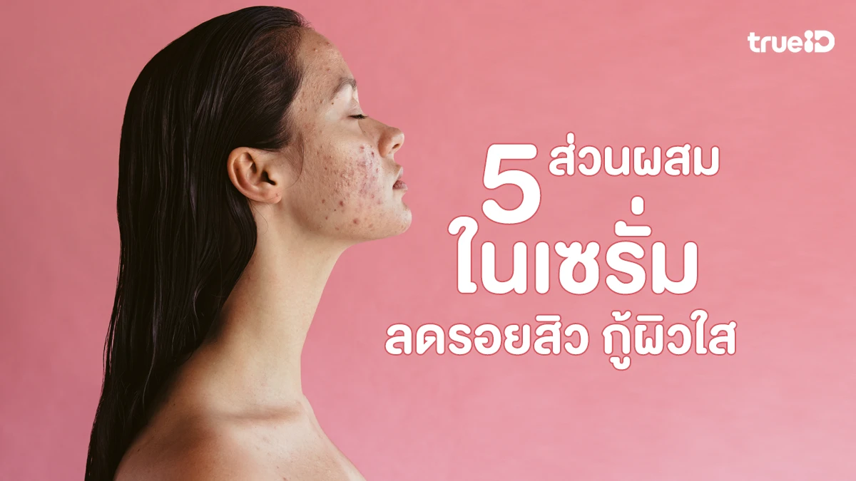 5 ส่วนผสมในเซรั่มที่ช่วยลดรอยดำจากสิว กู้ผิวใส ไม่ต้องกังวลอีกต่อไป! 5 ส่วนผสมในเซรั่มที่ช่วยลดรอยดำจากสิว กู้ผิวใส ไม่ต้องกังวลอีกต่อไป!